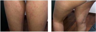 Case Report: Refractory Chronic Spontaneous Urticaria Treated With Omalizumab in an Adolescent With Crohn’s Disease 